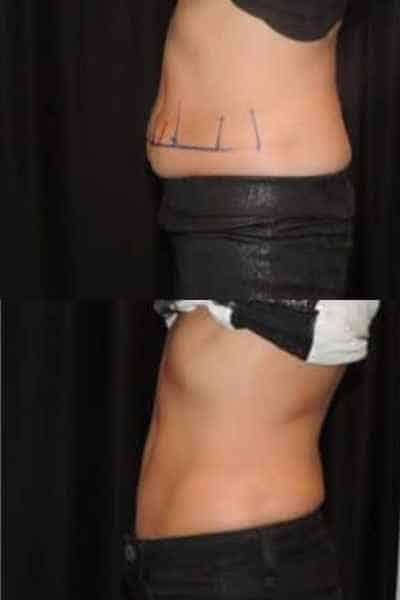 HIEMT Muscle Toning Falkirk