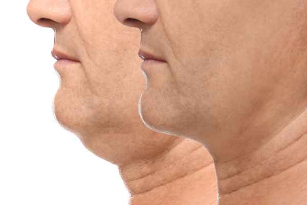 HIFU - Breakthrough in Anti - ageing 2 hifu results Falkirk