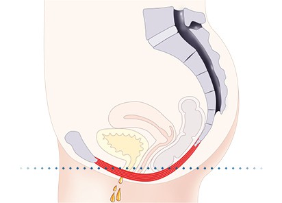 Pelvic-Floor Muscle Repair 5 Pelvic floor muscles Falkirk