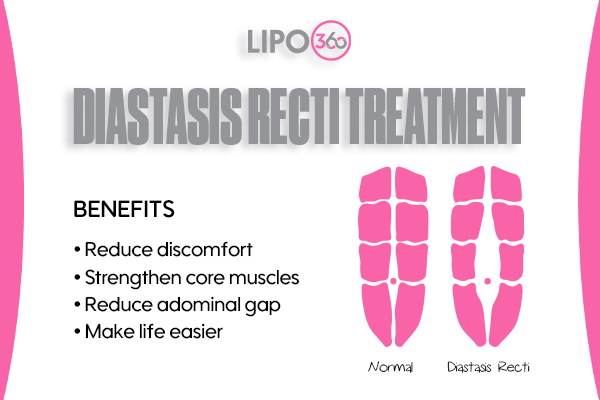Revolutionising Muscle Repair: The Power of LIPO360 Body Sculpt Post-Injury 5 diastasis recti treatment Falkirk