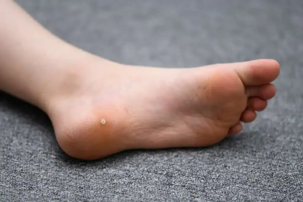 Cryotherapy For Warts And Also Verrucas 2 Image of verruca on the bottom of the foot that able to be treated with Cryotherapy Falkirk