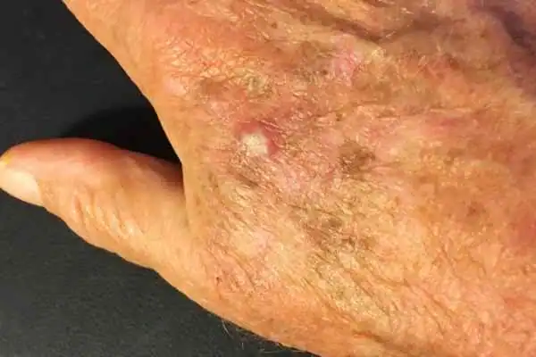 Cryopen For Actinic Keratoses 1 Image of Actinic keratoses Falkirk on a person hand