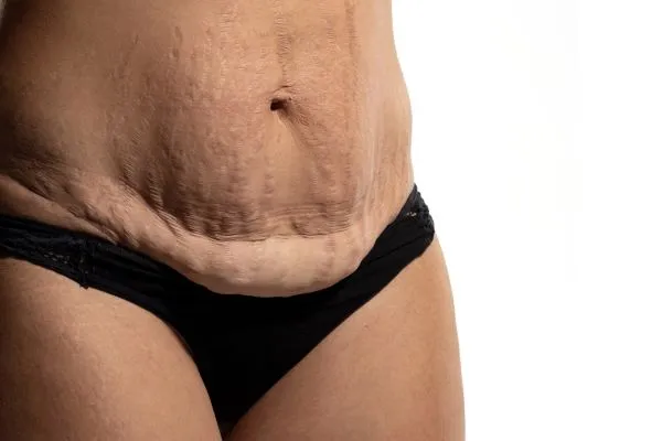 The science behind skin tightening Falkirk picture of a woman's sagging skin on the stomach